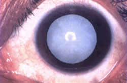 白内障で濁った眼球（例）